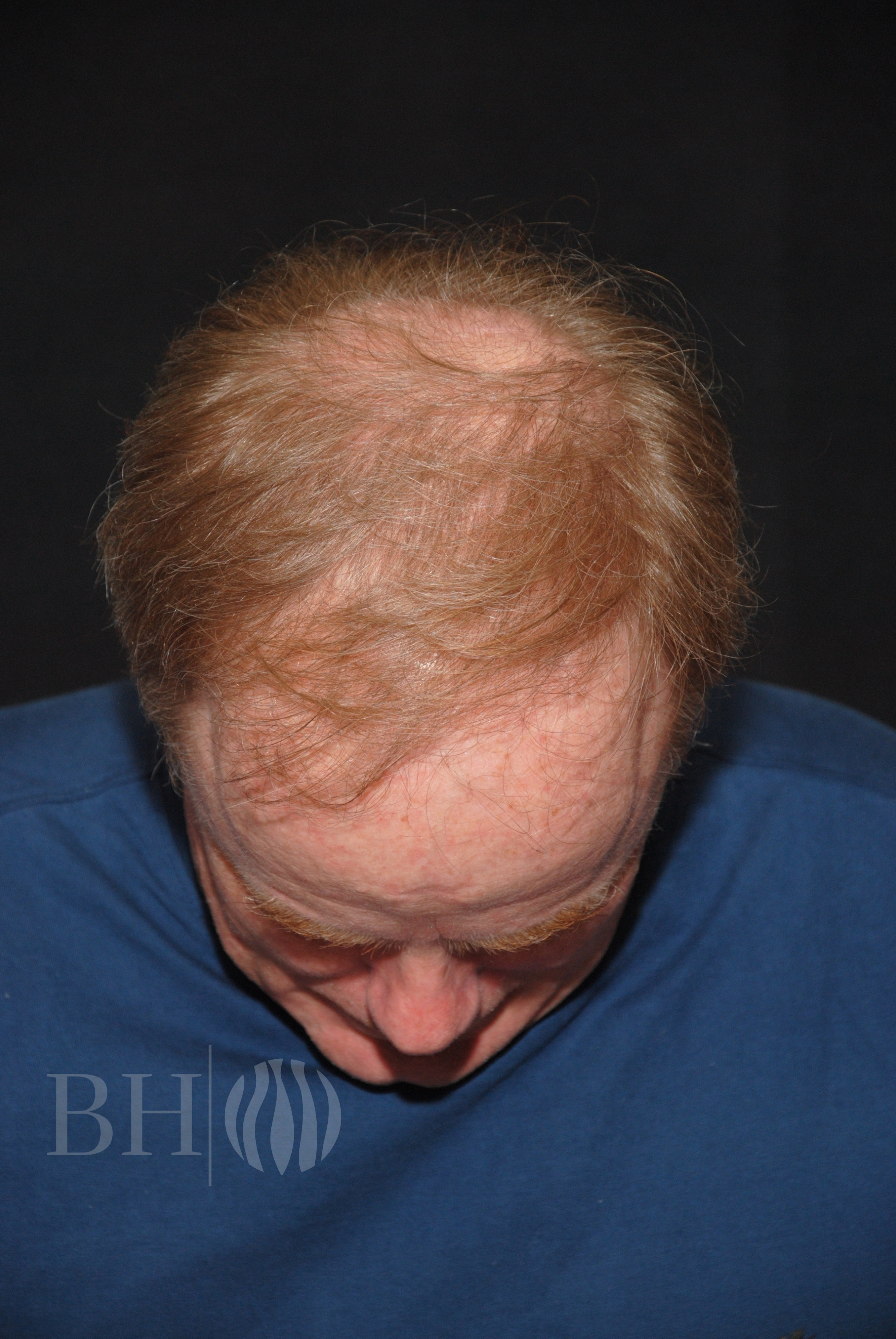 Neograft hair Before and After